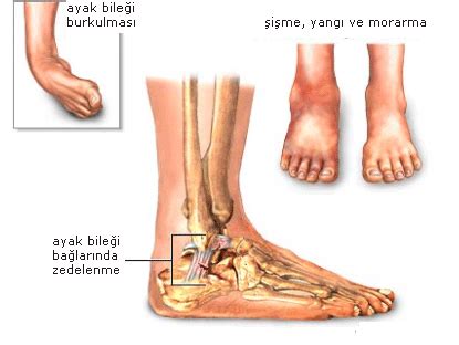 ayak bileğinin travma sonrası artrozu nasıl tedavi edilir